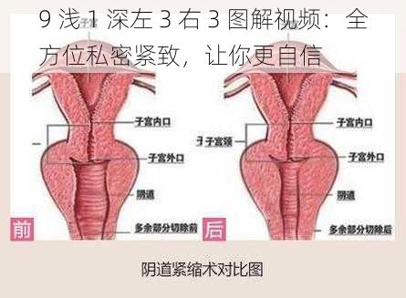 9 浅 1 深左 3 右 3 图解视频：全方位私密紧致，让你更自信